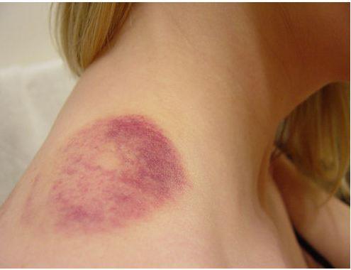Bruise Like Spots On Leg - Undiagnosed Symptoms - MedHelp