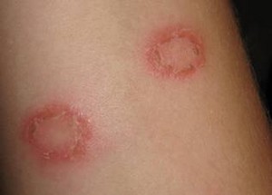 How to Get Rid of Ringworm fast