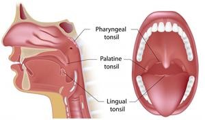 tonsil-stones