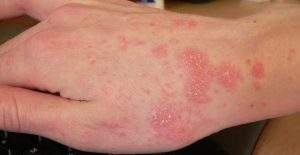 How to Get Rid Of Scabies