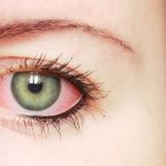 Home Remedies for Itchy Eyes