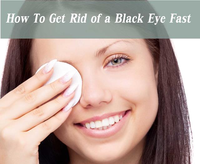 How to Get Rid of a Black Eye Fast