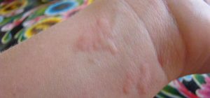 How to Get Rid of Hives