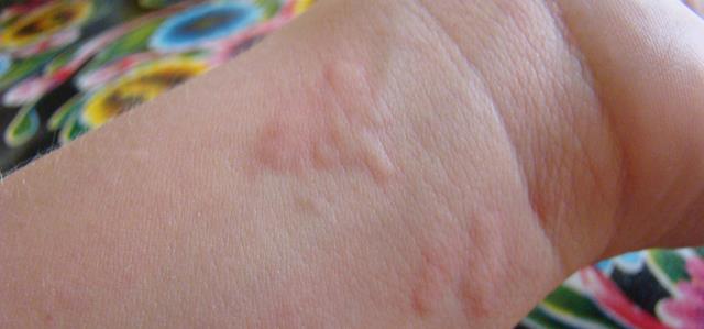 How to Get Rid of Hives