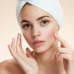 Ways to get rid of Acne