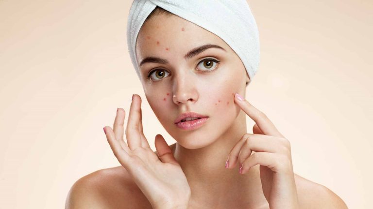 100 Ways to get rid of Acne