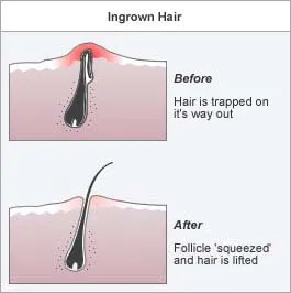 ingrown hair rid appearance