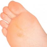 How to Get Rid of Calluses on Feet