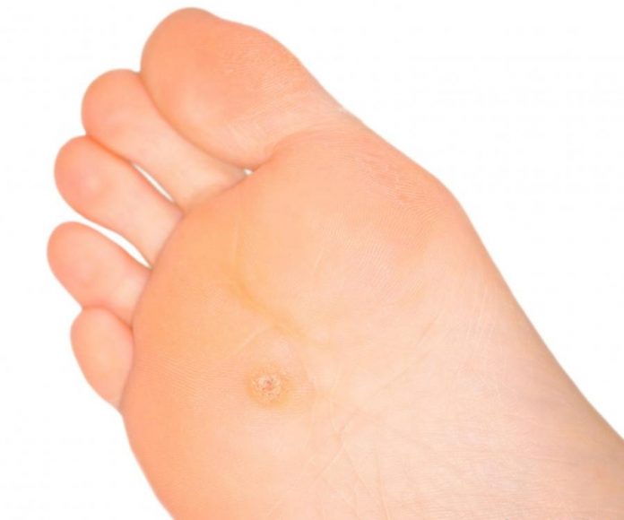 How To Get Rid Of Calluses On Feet