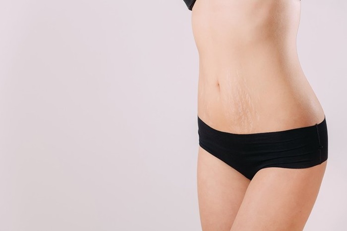 15 Effective Home Remedies About How To Prevent Stretch Marks