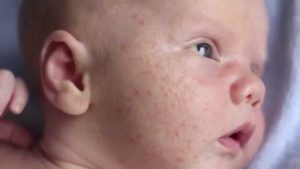 How to Get Rid Of Baby Acne