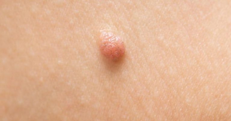 How to Get Rid of Skin Tags