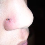 Bump on Nose Piercing