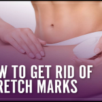 get rid stretch marks