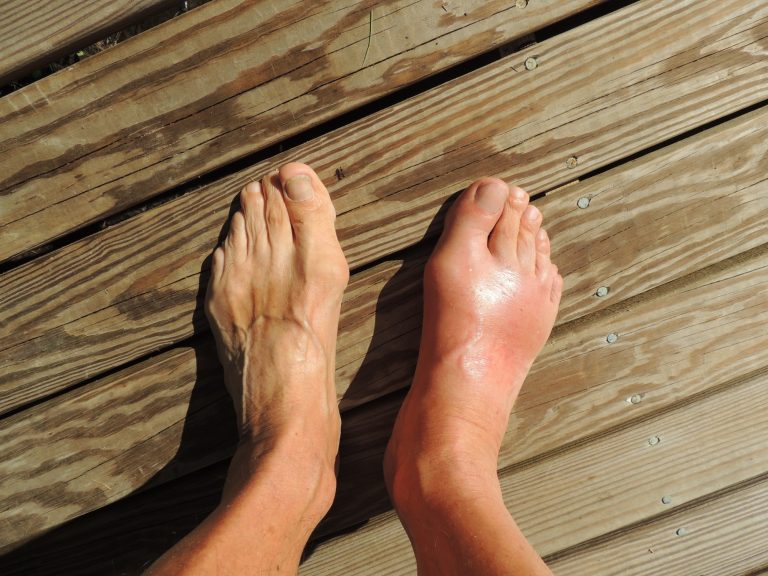 How to Treat Gout With Diet or Medication
