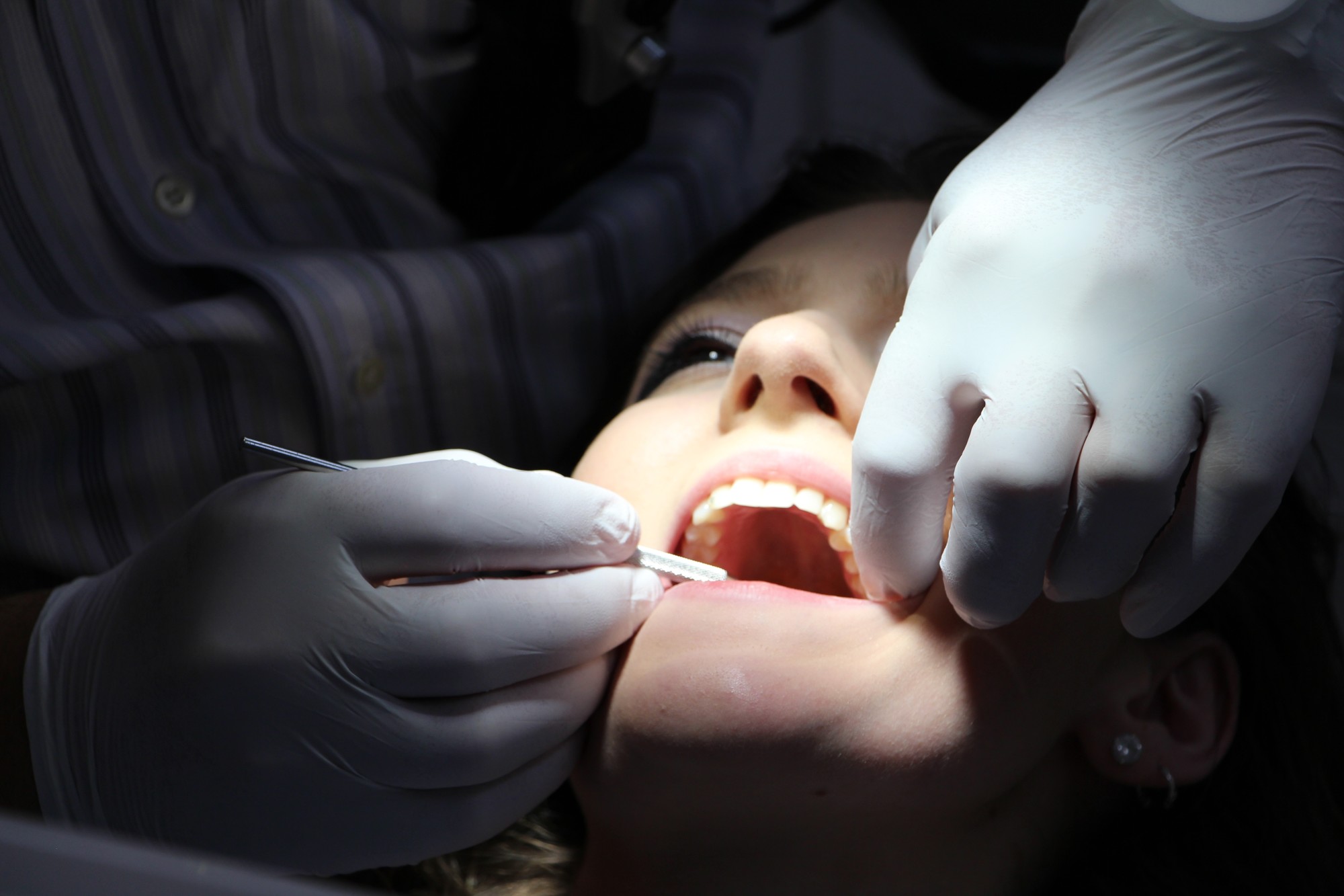 dental crown vs veneer